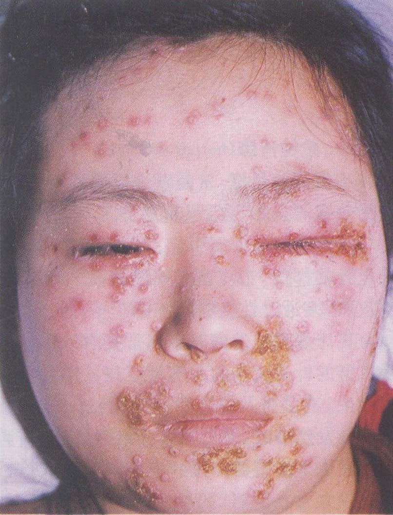 二、水痘